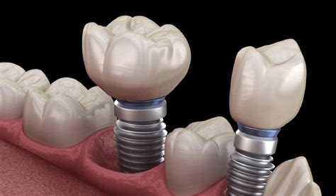 Affordable Dentures & Implants Near Me 